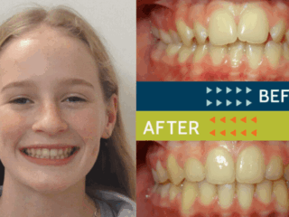 Springfield Orthodontics - Before and After Orthodontic Treatment