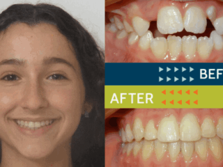 Springfield Orthodontics - Before and After Orthodontic Treatment