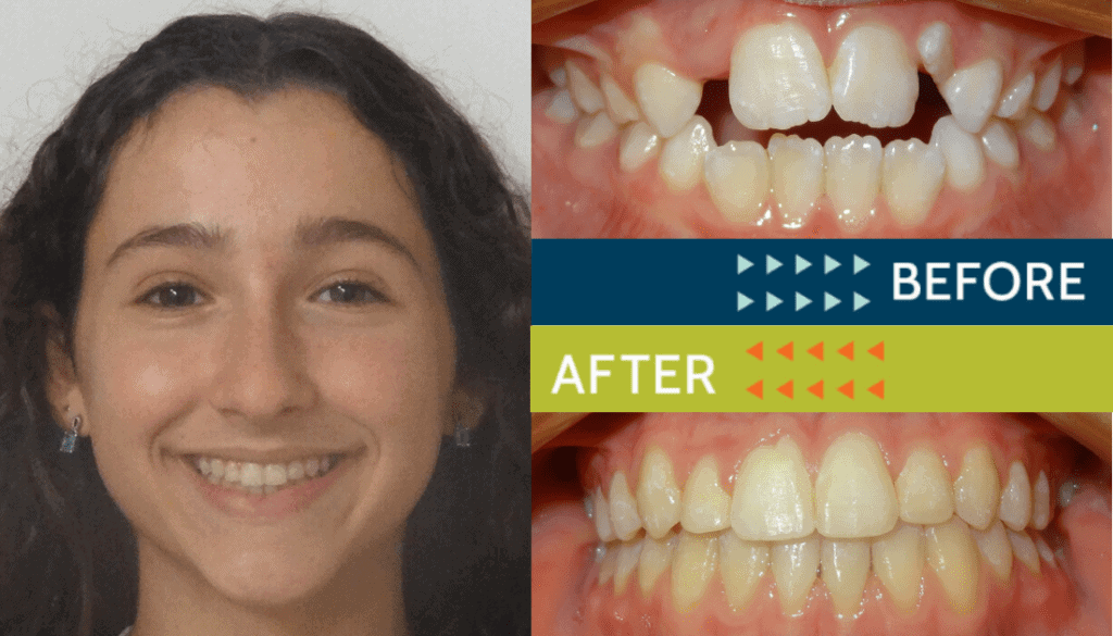 Springfield Orthodontics - Before and After Orthodontic Treatment