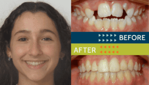 Springfield Orthodontics - Before and After Orthodontic Treatment