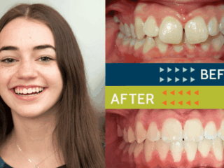 Springfield Orthodontics - Before and After Orthodontic Treatment