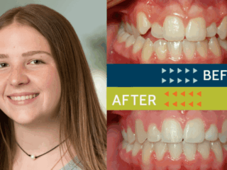 Springfield Orthodontics - Before and After Orthodontic Treatment