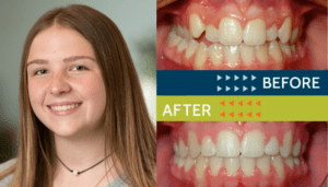 Springfield Orthodontics - Before and After Orthodontic Treatment