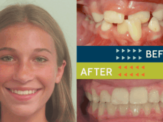 Springfield Orthodontics - Before and After Orthodontic Treatment