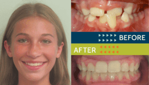 Springfield Orthodontics - Before and After Orthodontic Treatment