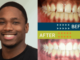 Springfield Orthodontics - Before and After Orthodontic Treatment