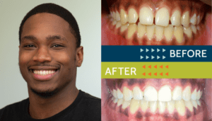 Springfield Orthodontics - Before and After Orthodontic Treatment