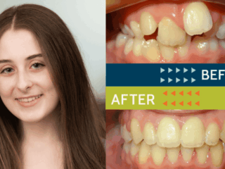 Springfield Orthodontics - Before and After Orthodontic Treatment