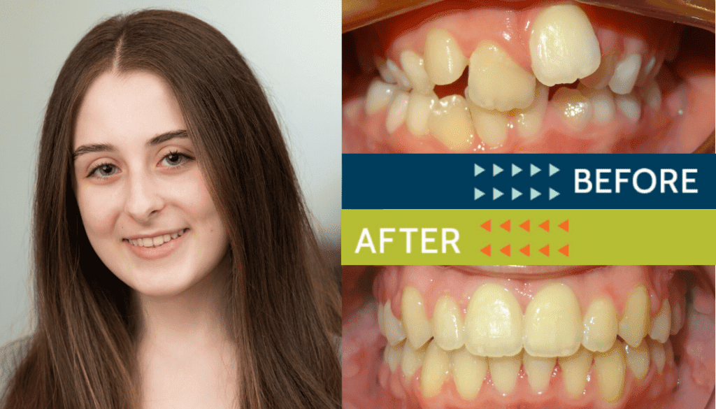 Springfield Orthodontics - Before and After Orthodontic Treatment