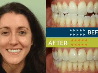 Springfield Orthodontics - Before and After Orthodontic Treatment