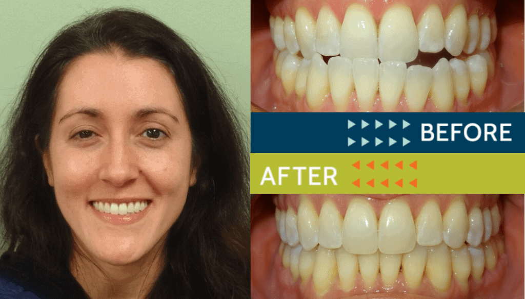 Springfield Orthodontics - Before and After Orthodontic Treatment