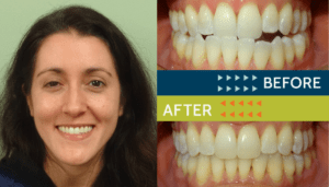 Springfield Orthodontics - Before and After Orthodontic Treatment