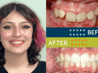 Springfield Orthodontics - Before and After Orthodontic Treatment