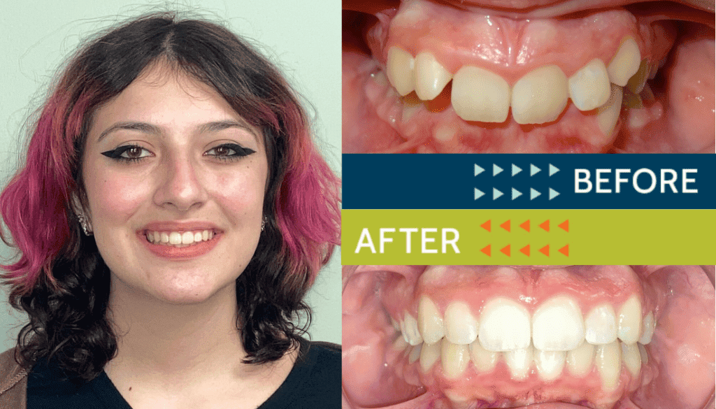 Springfield Orthodontics - Before and After Orthodontic Treatment